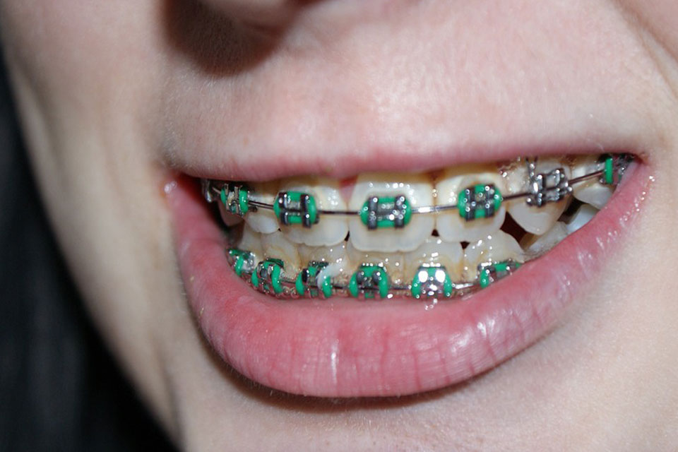 Braces Dream Meaning and Interpretation Dream Glossary