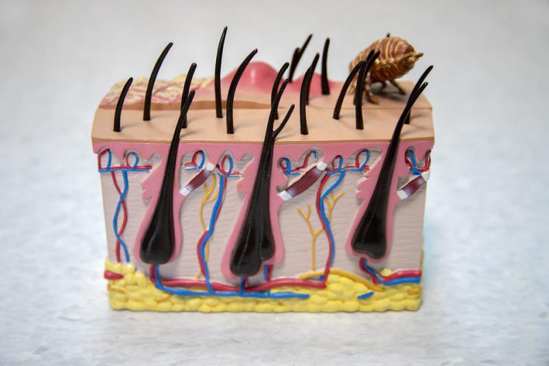 Medical model of a section of the scalp and follicles with scabies specimen of scalp section and follicles with scabies